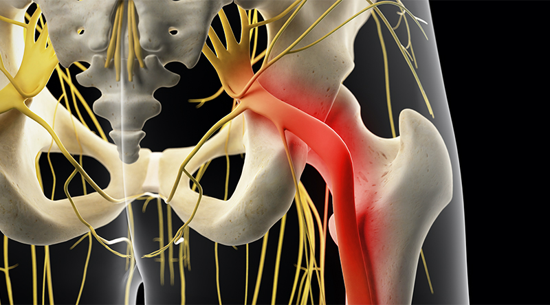 What is Sciatica?